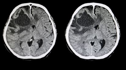 Clinical Trial Points to Treatment Advances for Glioma Patients for First Time in Decades