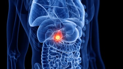 Gallbladder Cancer: Progress and Hope for Future Breakthroughs