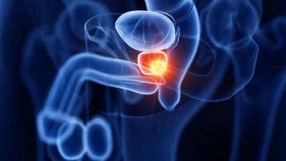 Study Finds Lower Mortality Rate for Men at High Risk for Death from Prostate Cancer Who Received Early Postoperative Radiation Therapy