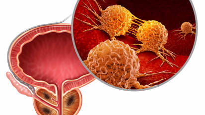 COVID-19 Research: Differences in Infection Rates for Men and Women and a Potential Link to Prostate Cancer