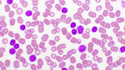 Triplet Therapy Shows Promise in Phase 2 Study in Chronic Lymphocytic Leukemia