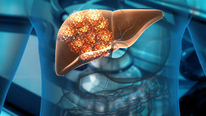 Tumor mutation associated with drug-resistant liver cancer, UT Southwestern study finds