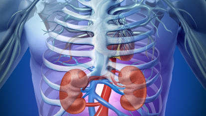 Hemodialysis Significantly Decreased for Patient with Primary Hyperoxaluria Type 1 in UCSF Study of Nedosiran