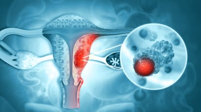 Global Study Holds Promise for Women Diagnosed with Endometrial Cancer