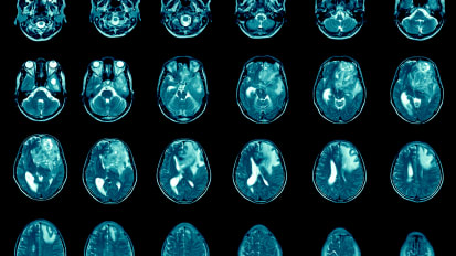 Cracking Glioblastoma’s Deadly Code: Research Focused on Improving Diagnosis and Genomics to Revolutionize Care