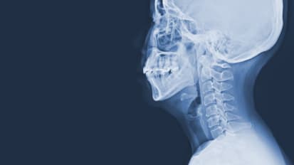 Cervical spinal cord morphometrics in degenerative cervical myelopathy: quantification using semi-automated normalized technique and correlation with neurological dysfunctions