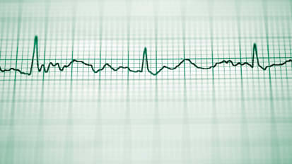 Using AI in Electrocardiogram Analysis Can Improve Diagnosis and Treatment of Hypertrophic Cardiomyopathy