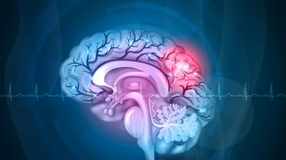 Switching from Alteplase to Tenecteplase for the Treatment of Ischemic Stroke