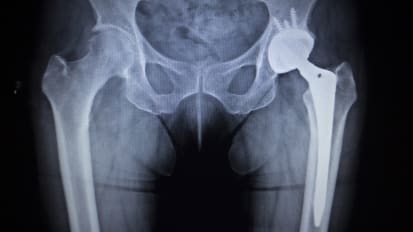 HIV patients can safely undergo hip replacement, study finds