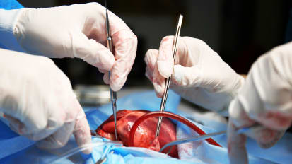Rare HeartMate 6 LVAD Saves Patient with Heart Failure After Chemotherapy