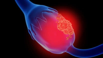 Stars of Cancer Research Align to Develop Ovarian Cancer Detection Test