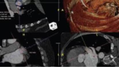 Advanced Diagnosis and Therapy for Paroxysmal Atrial Fibrillation and Chronic Blood Loss Anemia