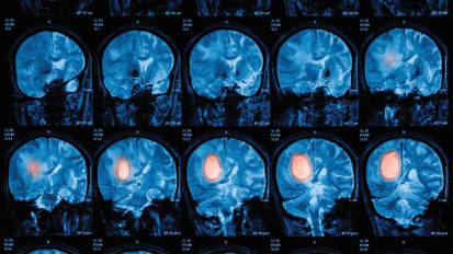 Advancing the Treatment of Brain Tumors