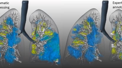 AI Model Helps Diagnose Severity of COVID-19 Pneumonia