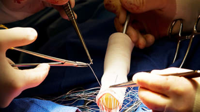 Joseph Bavaria, MD, and International Thought Leaders Review Aortic Valve Repair