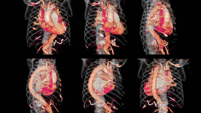 Treating the Spectrum of Aortic Disease