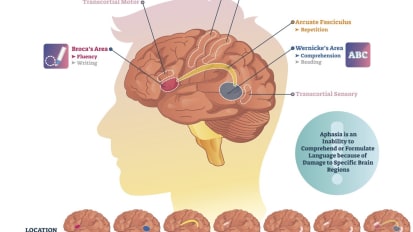 Break the Silence of Aphasia with Specialized Speech-language Rehab