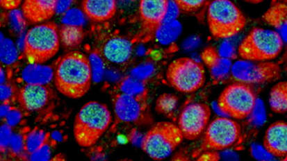 Hearing Loss & Autism