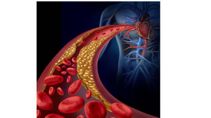 Lipoprotein(a) and Heart Health: The Importance of This Inherited Cholesterol-Related Protein