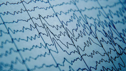 Baptist Health Miami Neuroscience Institute and FIU’s Herbert Wertheim College of Medicine Partner to Study Effects of Ultrasound Waves on the Brain
