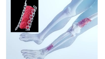 Miami Orthopedics & Sports Medicine Institute is First to Implant 3-D Printed ‘Graft Cage’ to Heal Long Bone Injury