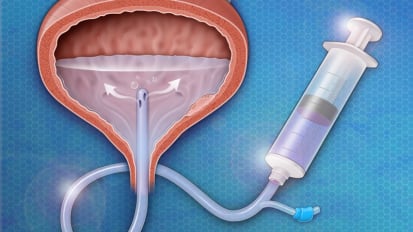 ENDING THE RELIANCE ON BCG<br><sub> A Phase III clinical trial for bladder cancer</sub>