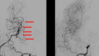 A Complex Surgical Repair for Aneurysm Highlights the Importance of a Multidisciplinary Stroke Team