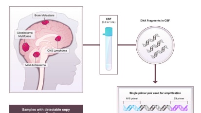 Investigators Devise Test to Identify Brain Tumors from Cerebrospinal Fluid