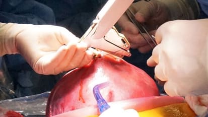 In Utero Surgery Gives Hope to Babies with Spina Bifida