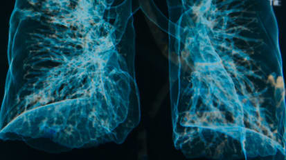 Unraveling Causes and Finding Treatments for COPD