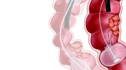 New Press Release: DiLumen EZ Glide Demonstrates Significant Benefits in Colorectal ESD