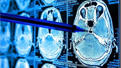 Roswell Park Presents ‘Highly Encouraging’ Phase 2A Results on SurVaxM Immunotherapy for Glioblastoma