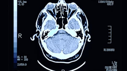 Rare Neurologic Disorder Identified