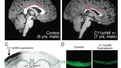 Gene Reveals Itself As Key Epigenetic Regulator in Neurodevelopmental Disorders