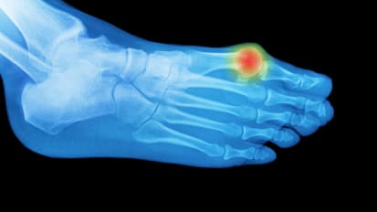 There’s No Reason to Put Off Bunion & Hammertoe Corrections 