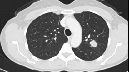 Winship at Emory’s Team Approach to Lung Cancer Care 