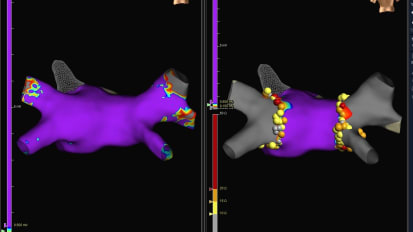 Changing Lives Through Cardiac Ablation