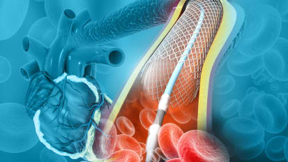 Chances of Receiving Percutaneous Coronary Intervention in a Low-Volume Facility are Increasing, Despite Worse Outcomes