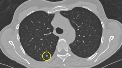 Mount Sinai Finds Lung Cancer Death Decline Associated With Screening, Earlier Diagnosis, and Surgery