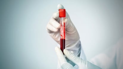 Will Circulating Tumor DNA Help Predict HPV-Related Throat Cancer?