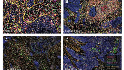 Myeloid Cell-associated Resistance to PD-1/PD-L1 Blockade in Urothelial Cancer Revealed Through Bulk and Single-cell RNA