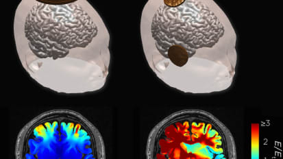 Experimental depression treatment preserves cognitive function