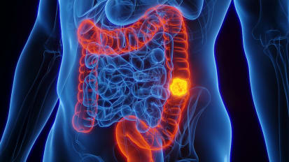 Personalized approach suggested on colorectal cancer screening