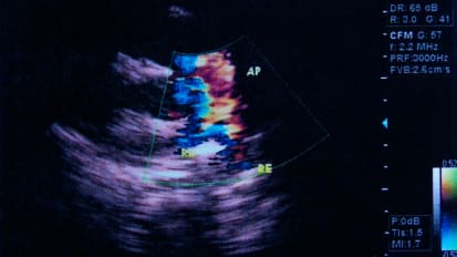 Congenital Heart Surgery Outcomes in Patients with Positive Respiratory Viral Swabs