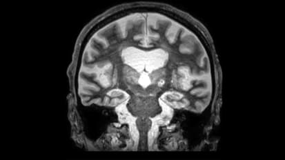 UTSW researchers use focused ultrasound to identify stroke biomarkers