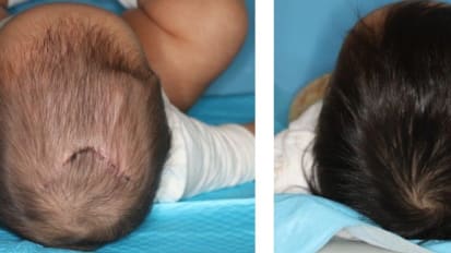 Spring-Mediated Cranioplasty in Sagittal Synostosis