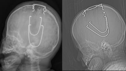 Advances In Craniosynostosis Repair