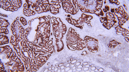 A Common Cancer at an Uncommon Age
