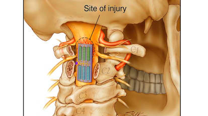 Developing Implantable and Wearable Technology to Treat Spinal Cord Injury