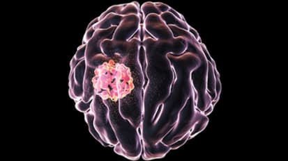 Experimental Vaccine for Brain Cancer Shows Preliminary Evidence of Generating an Immune Response